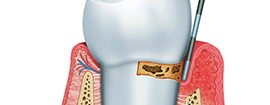 歯周病治療・予防診療